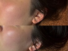 ゴールデンエイジ 吉祥寺(GOLDEN AGE)/ワックス脱毛：施術