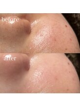 薫風/毛穴洗浄／20代