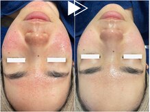 リシェス(Richesse)/赤ら顔改善ハーブ★初回¥9990