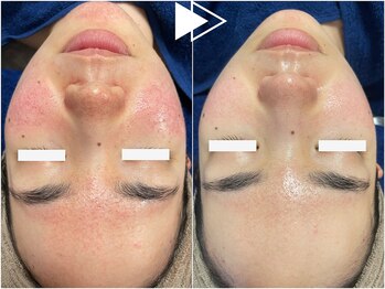 リシェス(Richesse)/赤ら顔改善ハーブ★初回¥9990