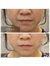【お顔引き締め効果抜群】表情筋トレーニングEMS¥6,600