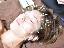 鍼屋フミ(鍼屋FUMI)/フェイスラインに鍼
