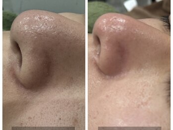 トータルビューティ リライフ(Total beauty Relife)/水素水ピーリング毛穴洗浄マシン