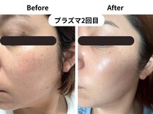 ビー(Be.)の雰囲気（〈プラズマ2回〉リフトアップ、ピンポイントのシミケアも可能◎）