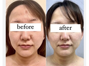 ラヴィアンローズ 忠節店(La vie en Rose)/小顔コルギ矯正 before→after