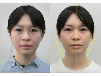 宮崎整体院/【小顔矯正・顔の歪み矯正】