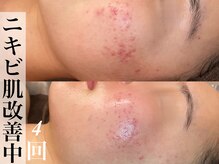 ビジュープラス 広島店(Bijou+)/【10代/繰り返しニキビ】