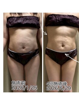 クールスパ(COOL SPA)/お腹症例