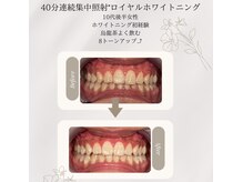 プラスビーセルフ(+b self)/ホワイトニングビフォーアフター