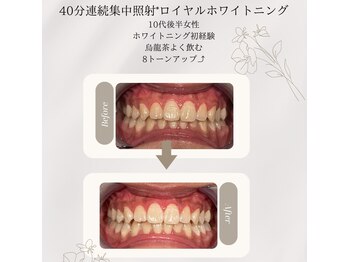 プラスビーセルフ(+b self)/ホワイトニングビフォーアフター