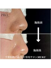 ムク(MUKU)/夏は皮脂量が増えます！