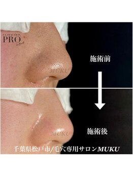 ムク(MUKU)/夏は皮脂量が増えます！