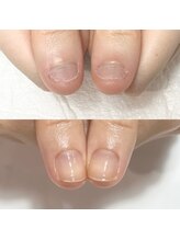 キュア(Cure.)/噛む癖の深爪緩和