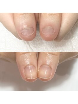 キュア(Cure.)/噛む癖の深爪緩和