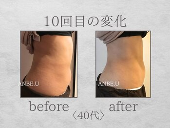 アンビーユー(ANBE.U)/腸もみビフォーアフター