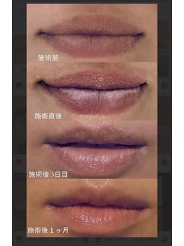 ファースト(1st)/ローマピンク【唇・リップ】