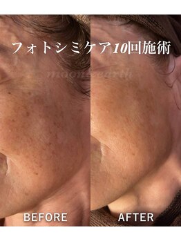 ムーンアンドアース(moon&earth)/フォト＆シミポイントケア