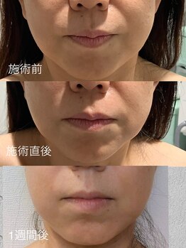 エムズ(emus.)/レモンボトルでお顔がスッキリ！