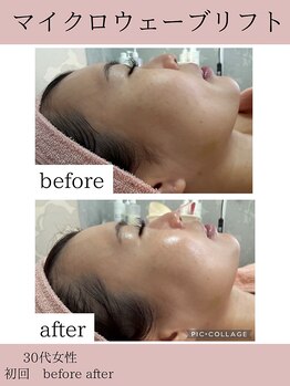 ココ(COCO)/マイクロウェーブリフト/小顔