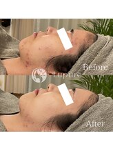 ルプレ(Lupure)/ハーブピーリング９回目