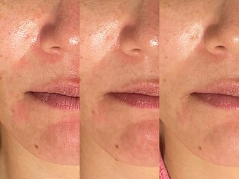 ゾーンビューティーハウス 柏店(ZONE BEAUTY HOUSE)/☆赤みが気になる方も☆