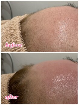 メローワックス 仙台東口店(MELLOW WAX)/【フェイスワックス脱毛】