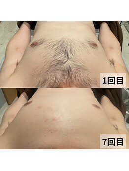 セイリキ(SEIRIKI)/脱毛