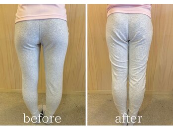 カイロラインメディカル整体 平塚院(Chiro Line)/産後骨盤矯正×お尻/beforeafter