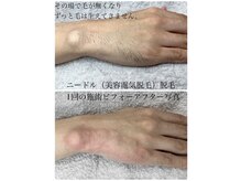 ハーチ 金沢店(8)/男性限定　美容電気脱毛60分