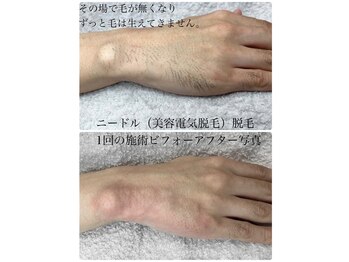 ハーチ 金沢店(8)/男性限定　美容電気脱毛60分