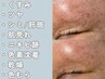 【西日本初取扱店】LDM幹細胞培養上精液導入+光フォト<シミケア/毛穴/美白>