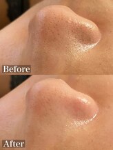 ラナ(Lana)/3D毛穴洗浄