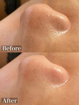 ラナ(Lana)/3D毛穴洗浄