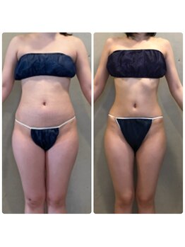 エクセレントビューティーサロン 艶(EN)/減量プログラム　１０ｋｇ減量