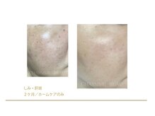 リンクアンドボーテ 大垣(Link&Beaute)/エイジングケア