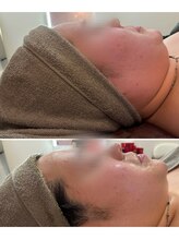 バルディーナ(BALDINA)/陶肌トリートメント