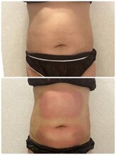 リアウェイク(Reawayke)/脂肪冷却1回目の効果