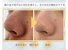 エレナ(ELENA)の雰囲気（ホームケアでは改善しにくい毛穴を剥離無しハーブピーリングで！）