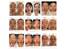  小顔・肌管理専門 NARA BEAUTY 表参道店【11/1 OPEN（予定）】の雰囲気（NARA式小顔コルギ）