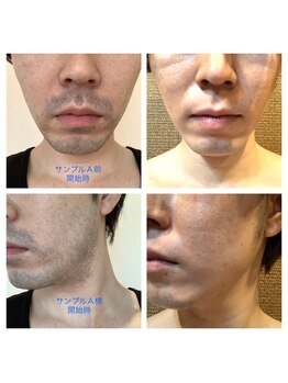 スパフランコルシャン(Spa Francorchamps)/メンズ脱毛【お顔ひげ脱毛】