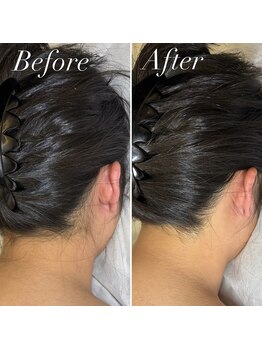 インベスト(INVEST)/うなじ脱毛