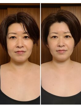 テマモリ(temamori)/施術ビフォーアフター