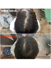 鍼灸チャンドラ(鍼灸Chandra)/髪のボリュームアップ効果も♪