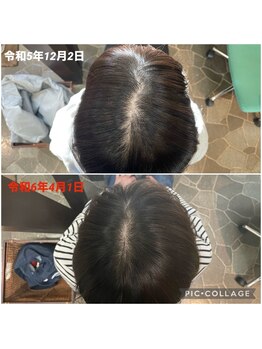 鍼灸チャンドラ(鍼灸Chandra)/髪のボリュームアップ効果も♪