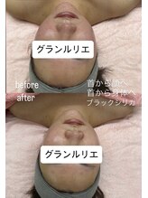 グランルリエ(Gran Rurier)/肌管理+超音波×ラジオ波
