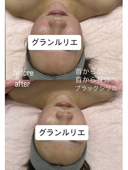 グランルリエ(Gran Rurier)/肌管理+超音波×ラジオ波