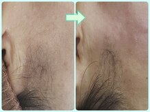 マニル アンド ネトラ(manil & netola)/どこから見ても綺麗なお顔に！