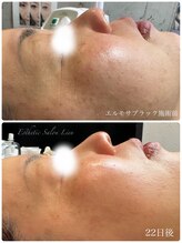 リアン 南熊本店(Lien)/ブラックハーブ　毛穴改善・痩身