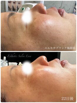 リアン 南熊本店(Lien)/ブラックハーブ　毛穴改善・痩身