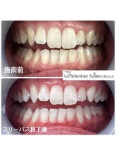 ホワイトニングサロン 京都烏丸店/ホワイトニング施術例